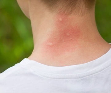 Beat the Itch this Summer with Country Boy!