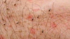 sand fly bites on skin